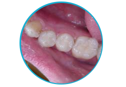 White Fillings Headington, Composite Fillings Oxford